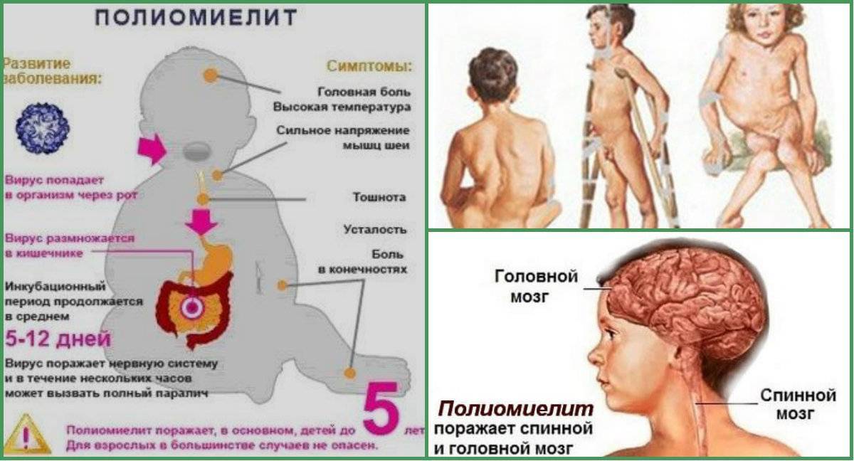 Полиомиелит