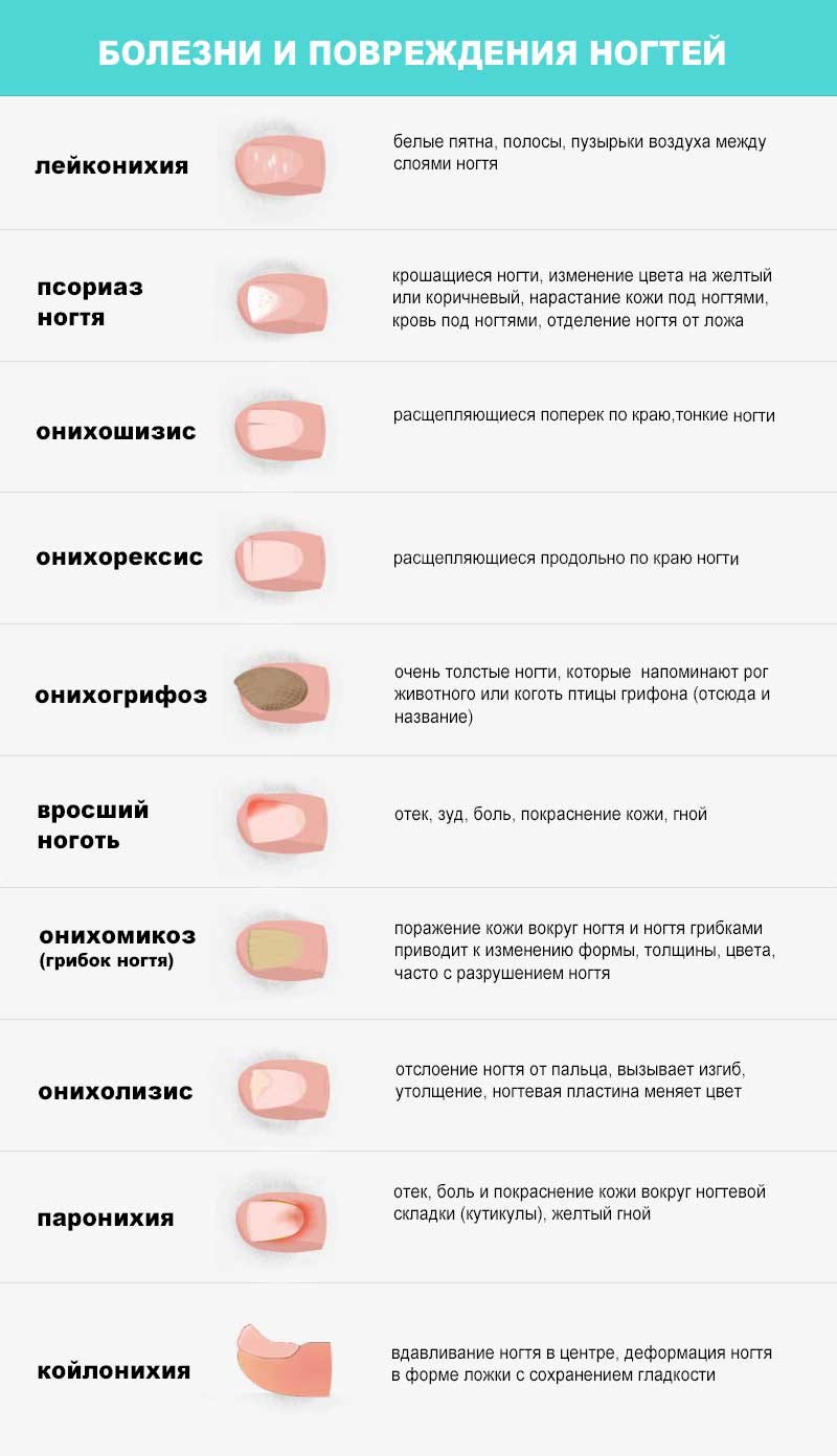 Как определить болезнь по ногтям
