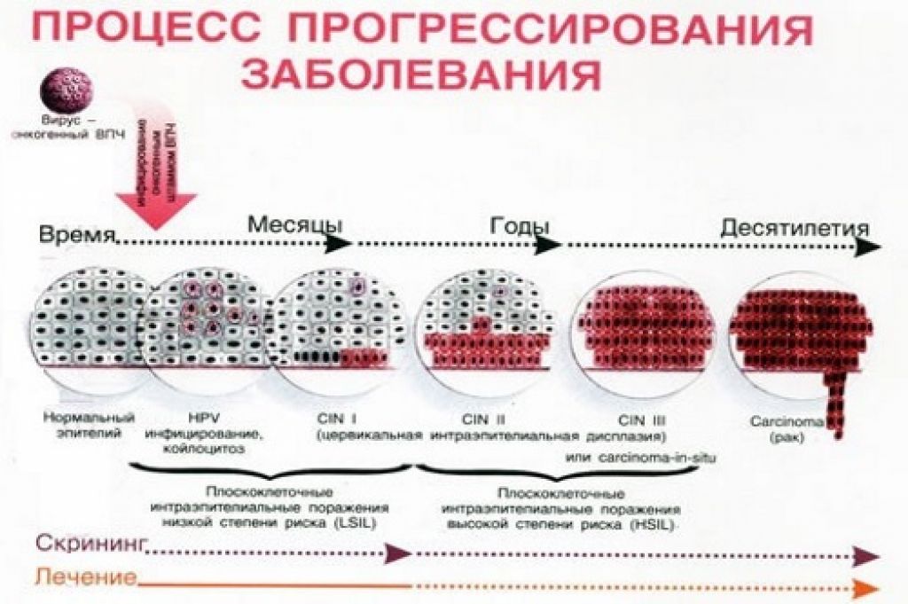 Впч 16, 18 типов: опасность, клинические проявления, лечение, фото