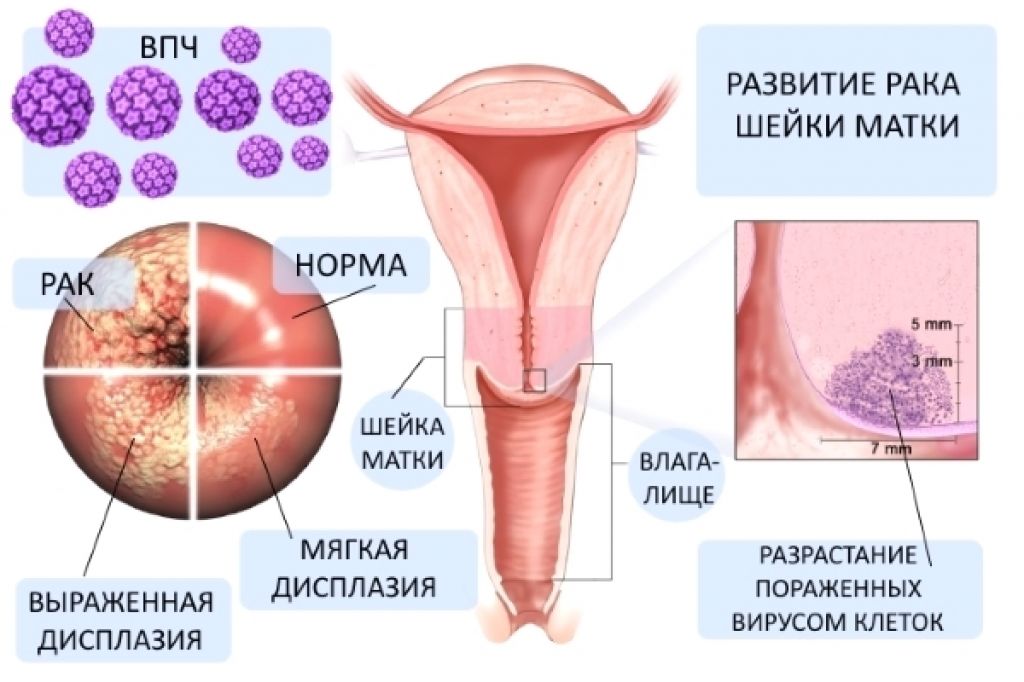 Вирус папилломы человека