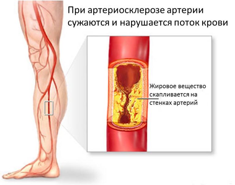 Гангрена