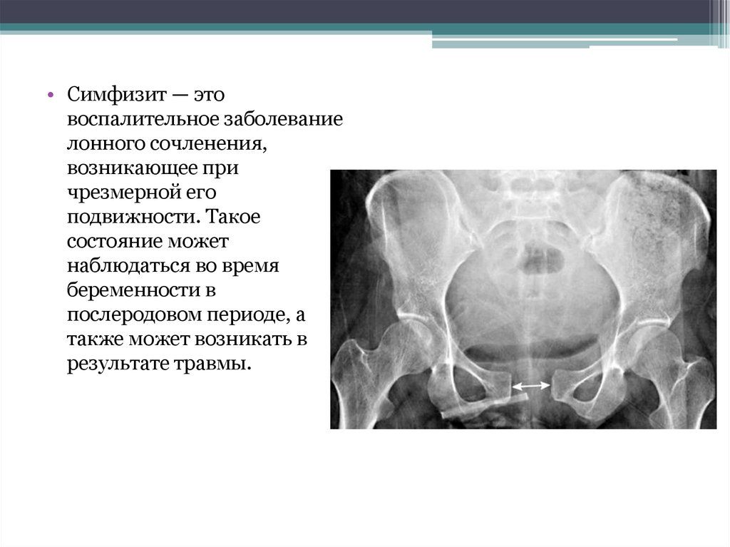 Симфизит при беременности - как распознать, терапия и возможные осложнения при родах