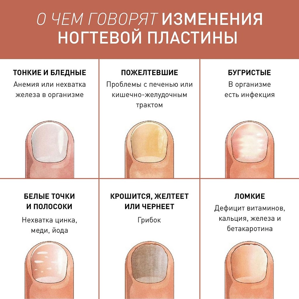 Диагностика по ногтям пальцев рук с фото - по форме, цвету и лунке