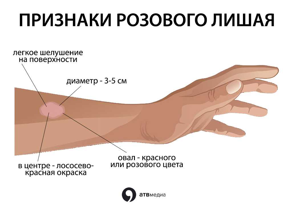 Стригущий лишай: как заразиться, профилактика, лечение, лишай у детей