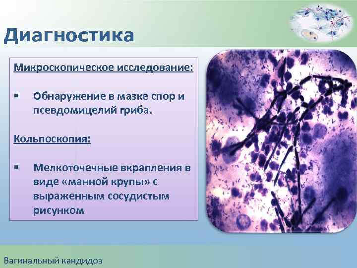 Вагинальный кандидоз: симптомы, причины, диагностика и лечение