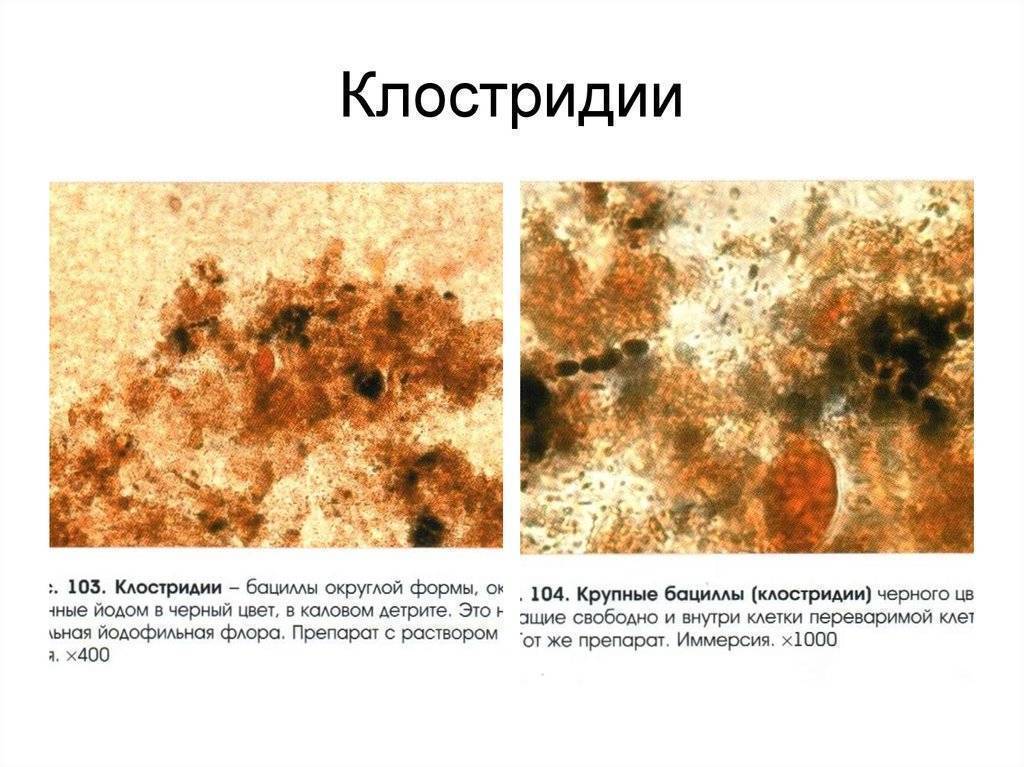 Йодофильная флора в кале у взрослого: причины и лечение