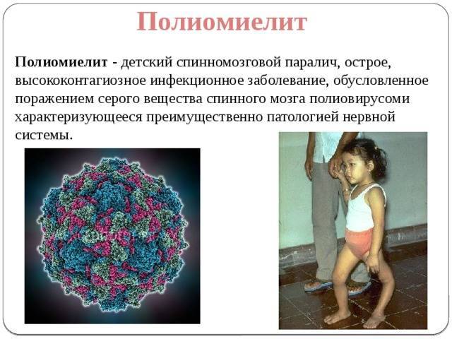 Что такое полиомиелит