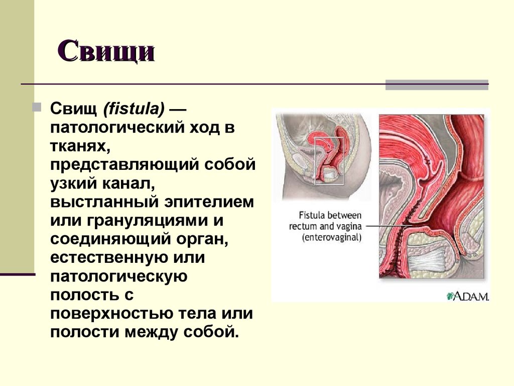 Параректальные свищи (свищи прямой кишки). лечение при свище прямой кишки . удаление свища прямой кишки.