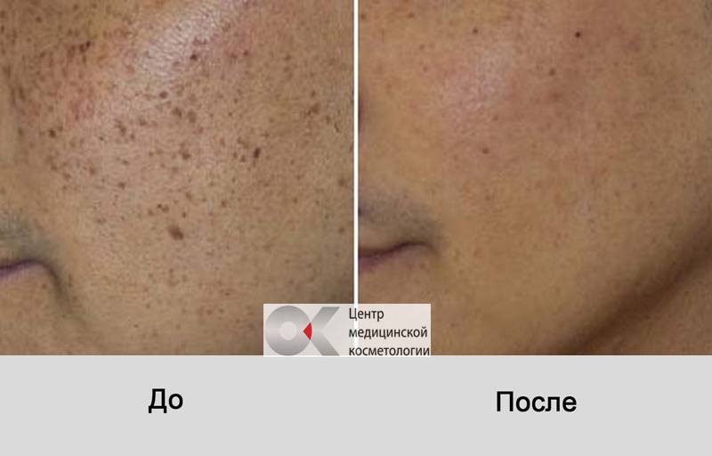 8 актуальных вопросов о черных точках на коже