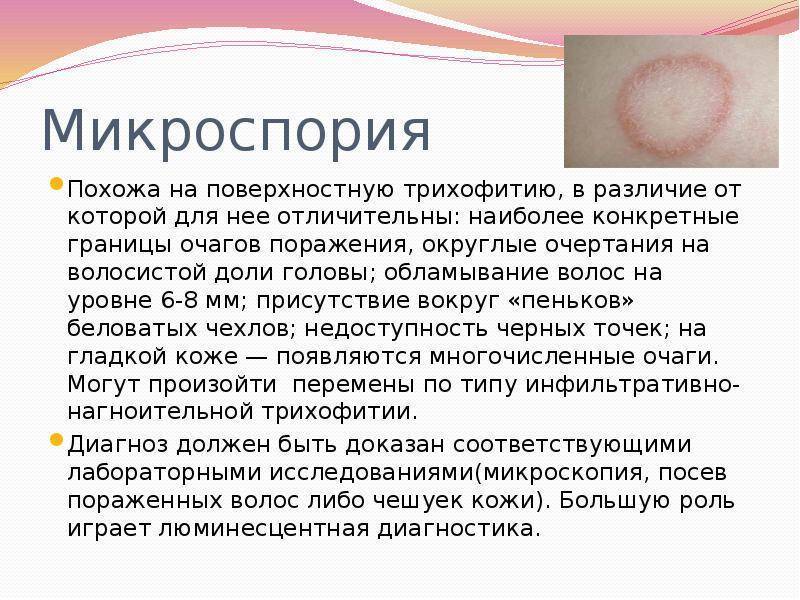 Профилактика и лечение лишая
