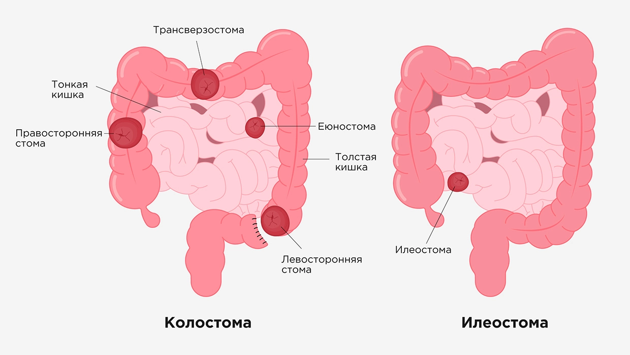 Онко вики — как ухаживать за стомой? где можно получить помощь?