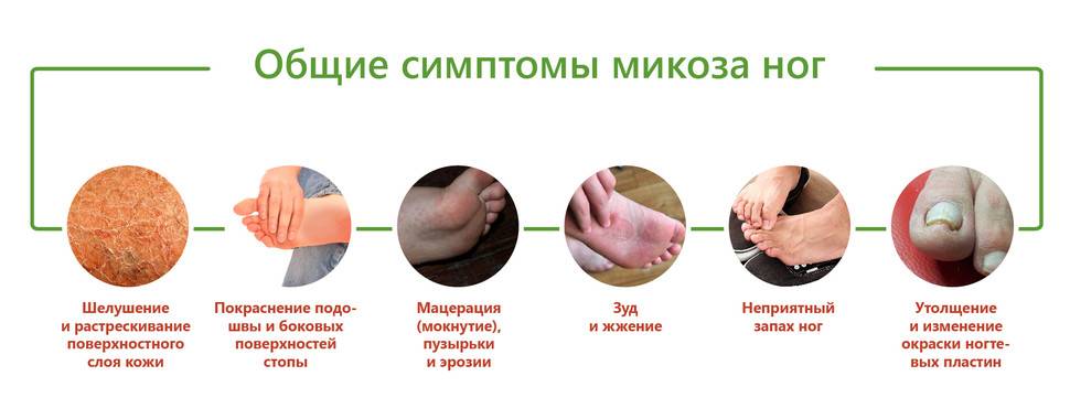 Грибковые инфекции влагалища ‒ советы гинеколога