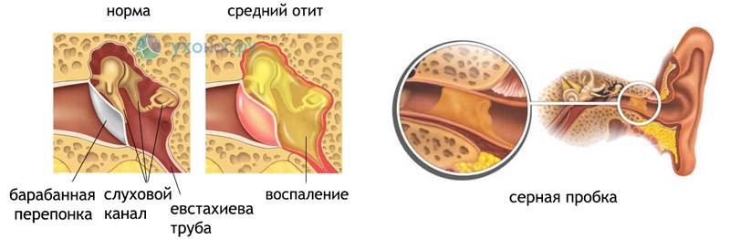 Фурункул в ухе: как лечить в домашних условиях, что делать фото симптомы