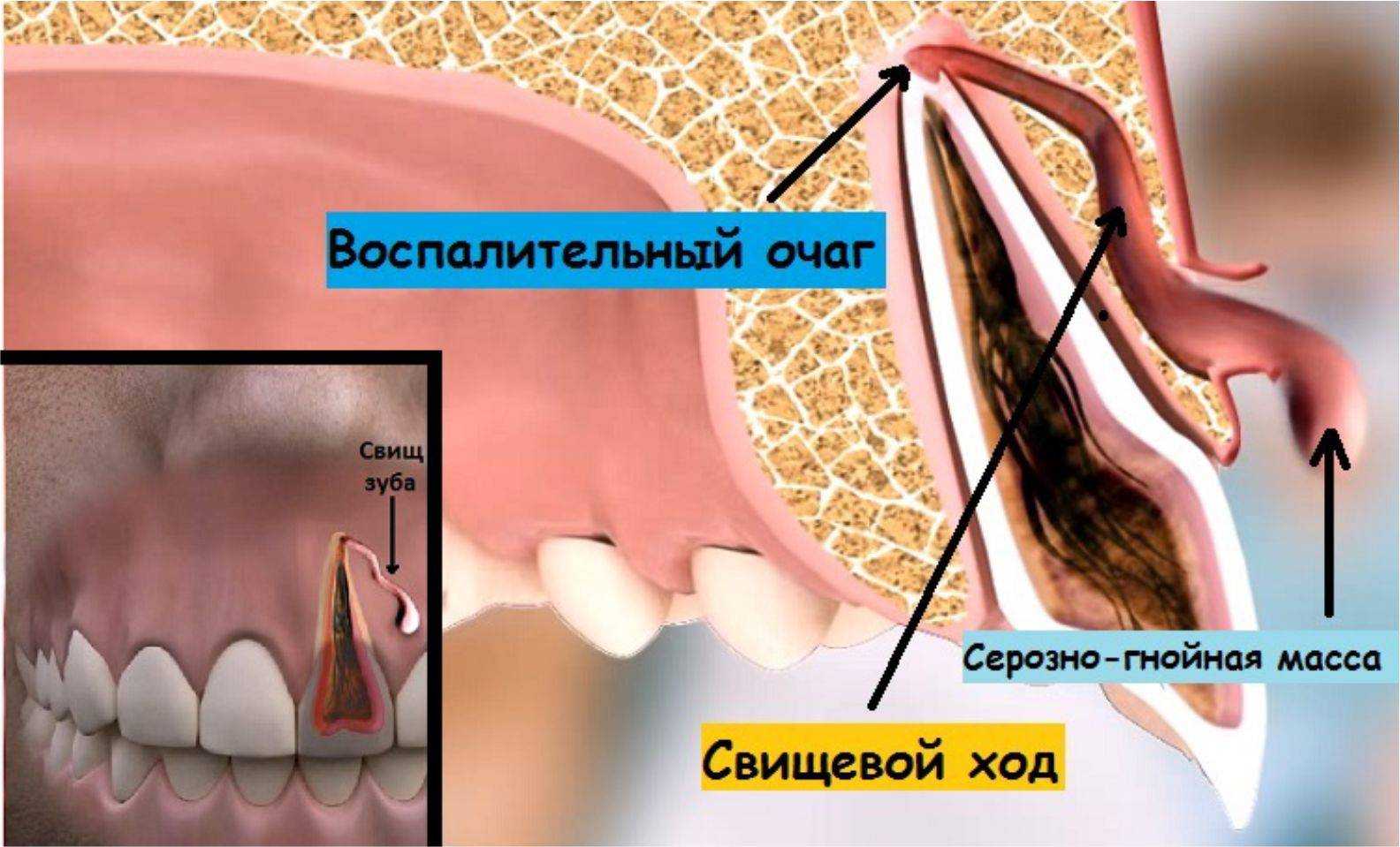 Свищ толстой кишки — surgery-first.ru