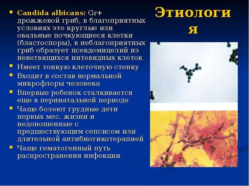 Вагинальный кандидоз