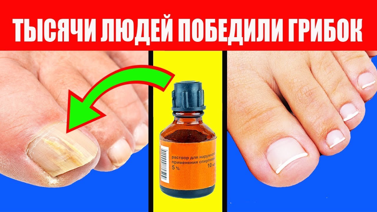Обработка обуви при грибке ногтей на ногах: общие сведения, методы борьбы с онихомикозом, препараты