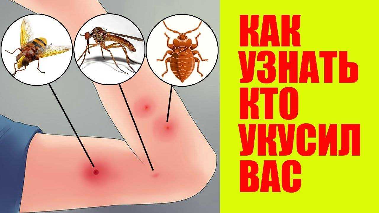 Укусы блох на коже человека: как распознать, насколько они опасны, чем обрабатывать