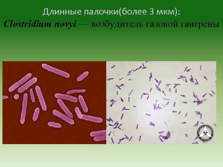 Газовая гангрена, лечение, причины, симптомы,  профилактика.