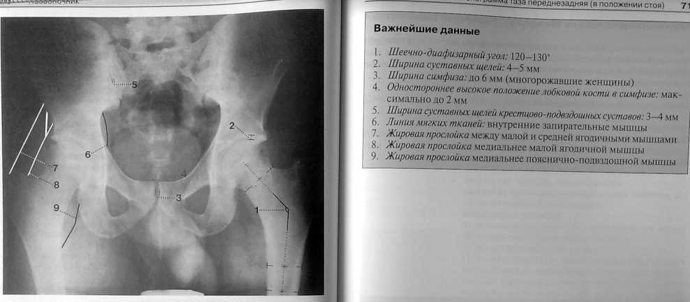 Симфизит при беременности: симптомы и лечение