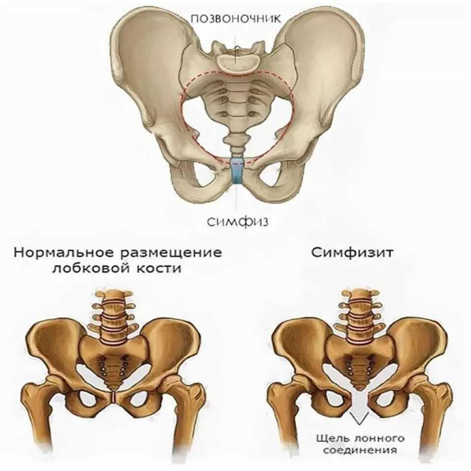 Дисфункция лобкового симфиза - kinesiopro