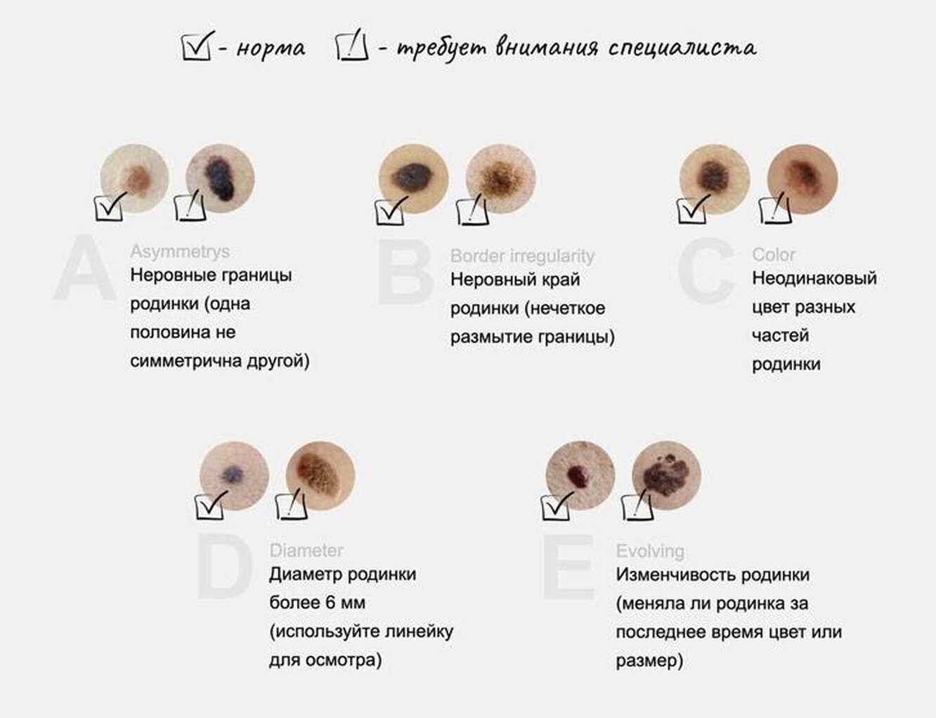 Симптомы меланомы: внешний вид, признаки метастазов | food and health