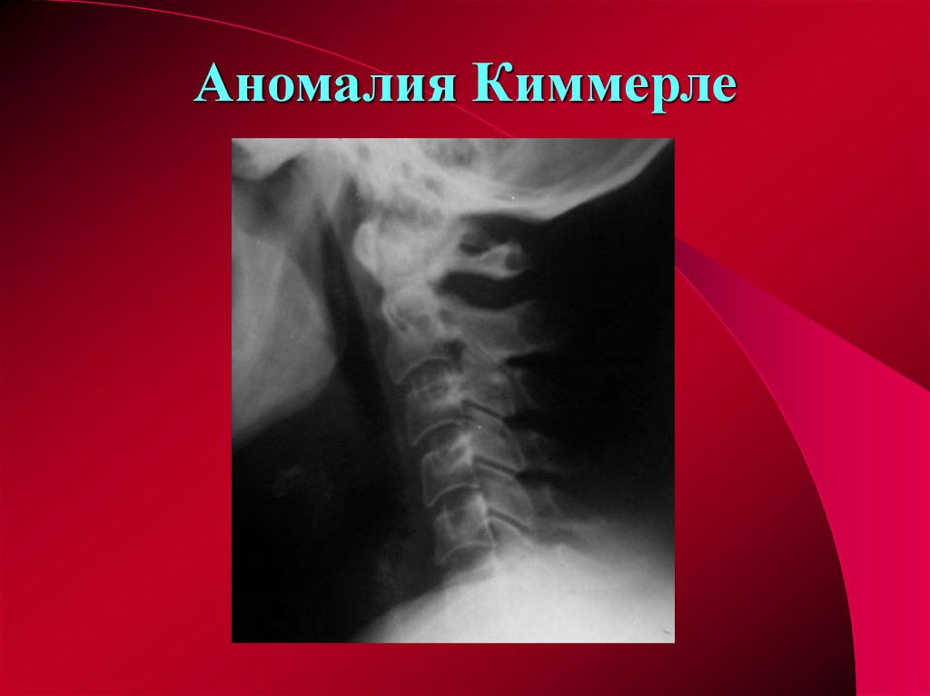 Причины и симптомы аномалии киммерле