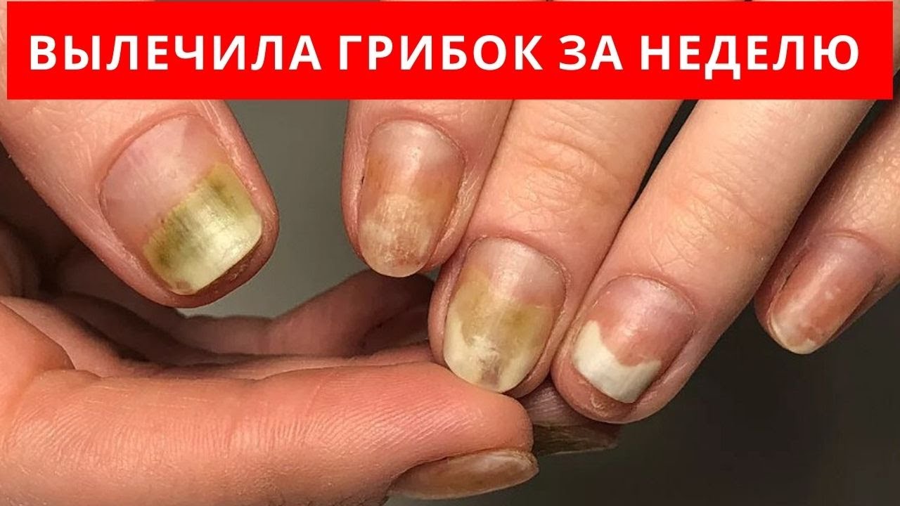 Симптомы поражения ногтей, ладоней вызывают дискомфорт Какие имеются лучшие народные средства от грибка на руках, как правильно их использовать Подберите рецепты для лечения