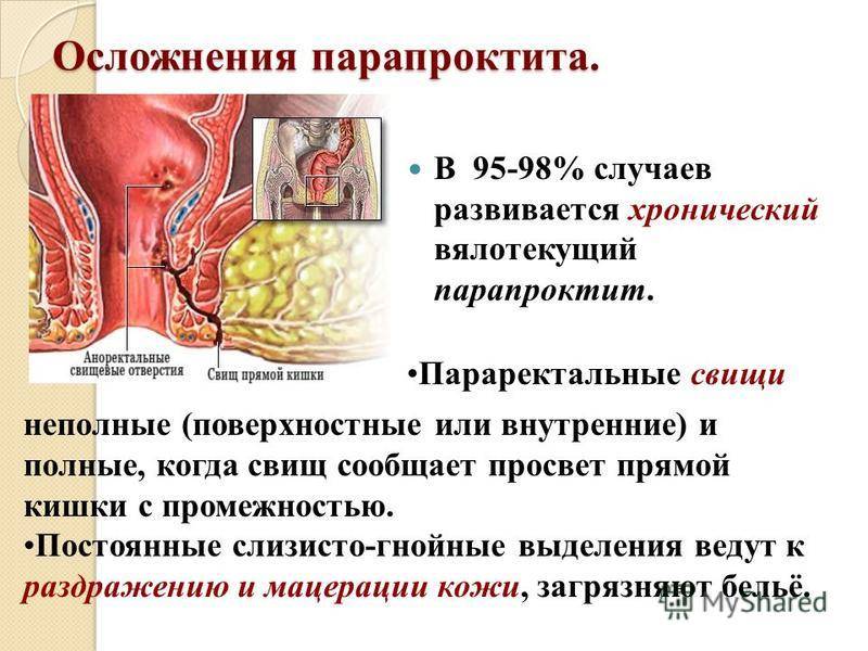 Свищ прямой кишки: что это такое, лечение без операции, причины возникновения параректального, экстрасфинктерного, парапроктит, обязательно ли удалять, симптомы